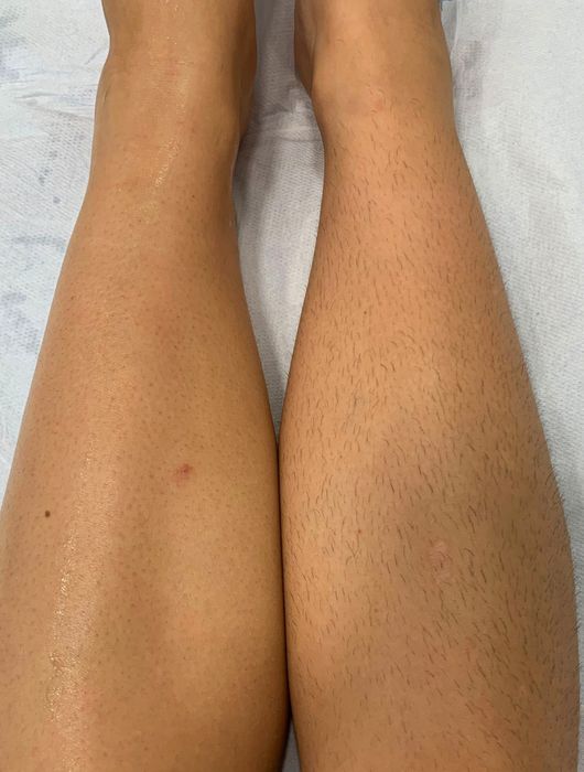 Epilare definitiva cu 4 lungimi de undă, cu ceara și tratamente