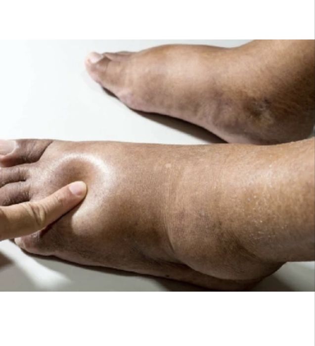 Costum drenaj limfatic, presoterapie