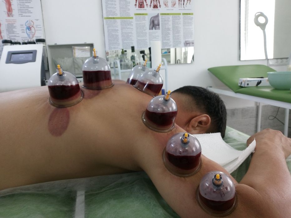 хиджама, массаж, диагностика, иглотерапия