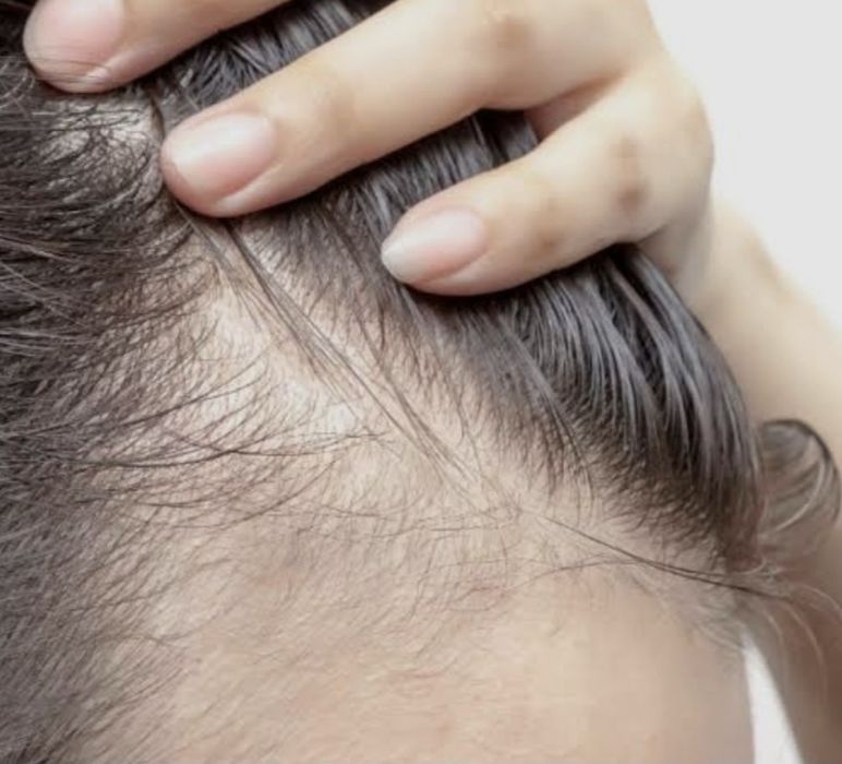 Plazmalifting,yuzga va soch tùkilishiga, Плазмалифтинг