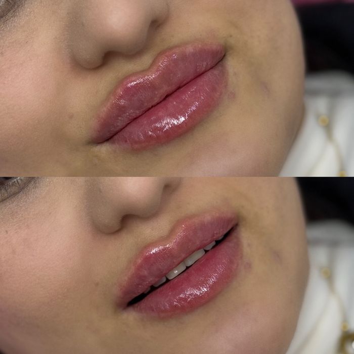 Увелечение губ филером