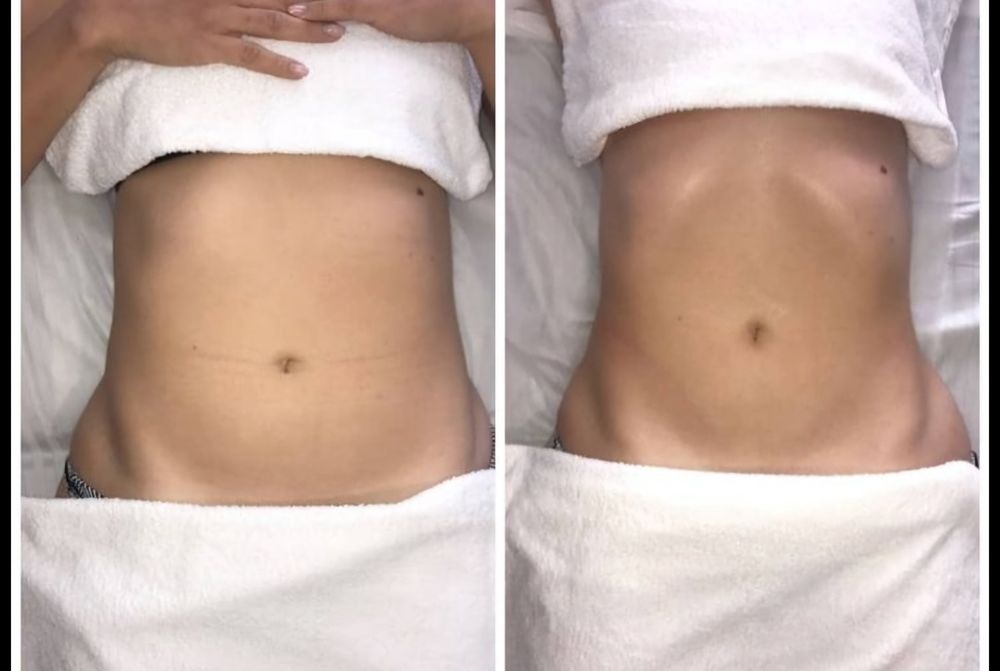 Drenaj limfatic manual