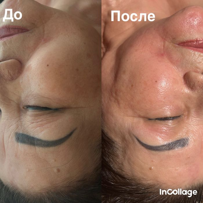 Продам аппарат Exilis 360!