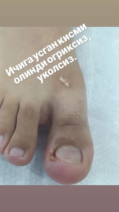 Ичига усган тирнони олиш, титановый нить куйиш хизматимиз бор. Ориксиз