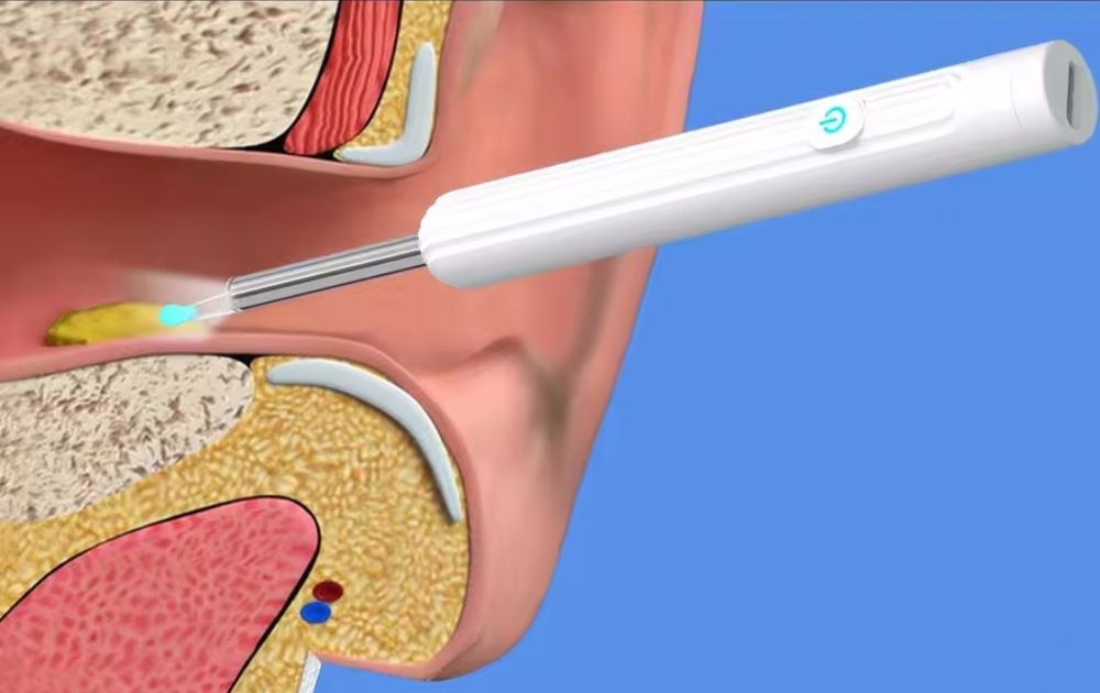 Инструмент за премахване на ушна кал.