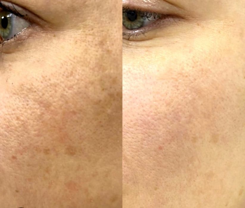 *Kosmetolog hizmatlari. Yuzdagi doglarni ketkazish