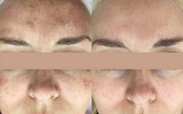 Мезотерапия, Mezoterapiya, Косметолог, Kosmetolog