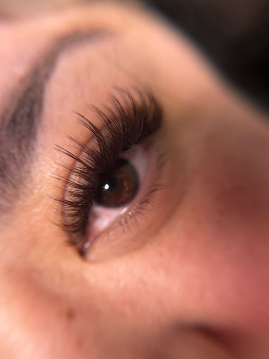 Chiska va karboksidterapyiya. Narashka.