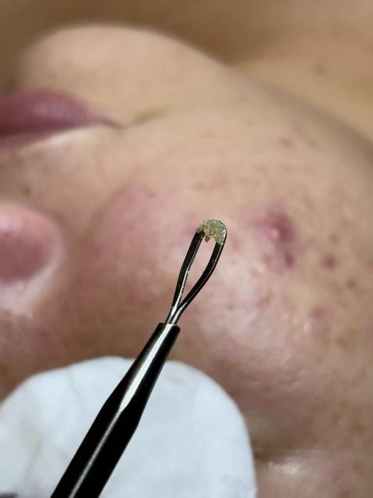 Cosmetolga chistka piling Erkeylar va ayollar uchun