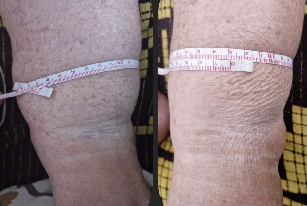 Drenaj limfatic manual post opertor bbl , liposuctie , abdominoplastie