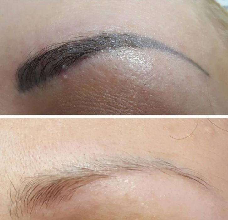 Удаление  татуажа и тату