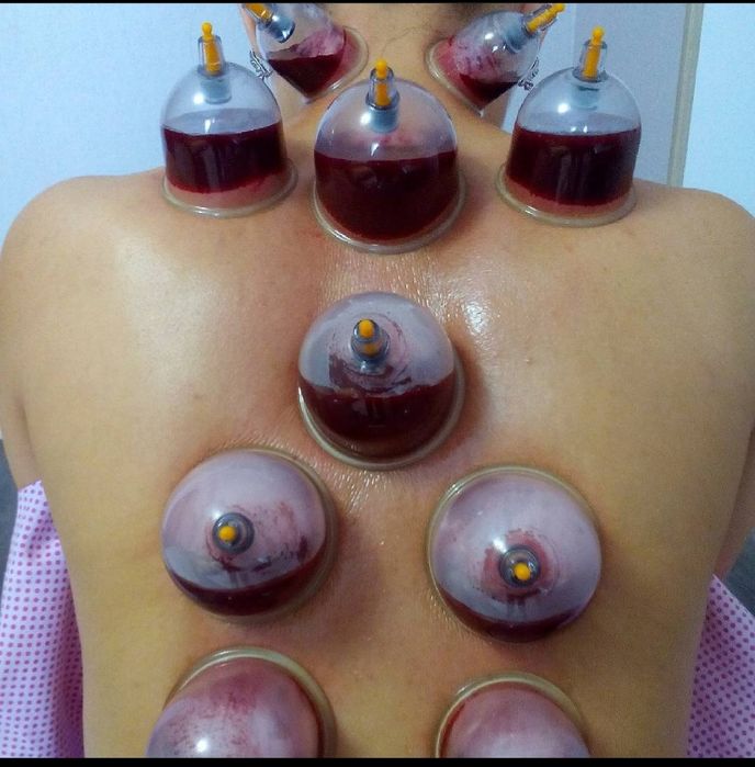 хиджама лечение по сунне.