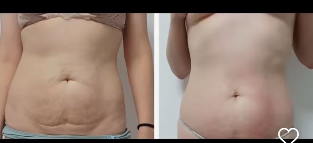 Продам аппарат Exilis 360!