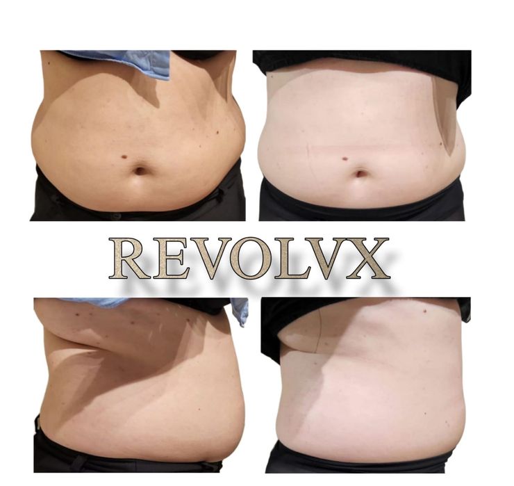 Vând aparat profesional de remodelare corporală și facială REVOLV-X