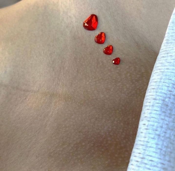 Лазерная эпиляция/Удаление татуажа