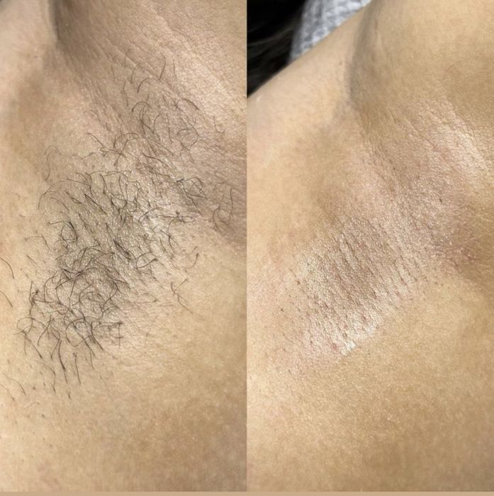 Депиляция воском