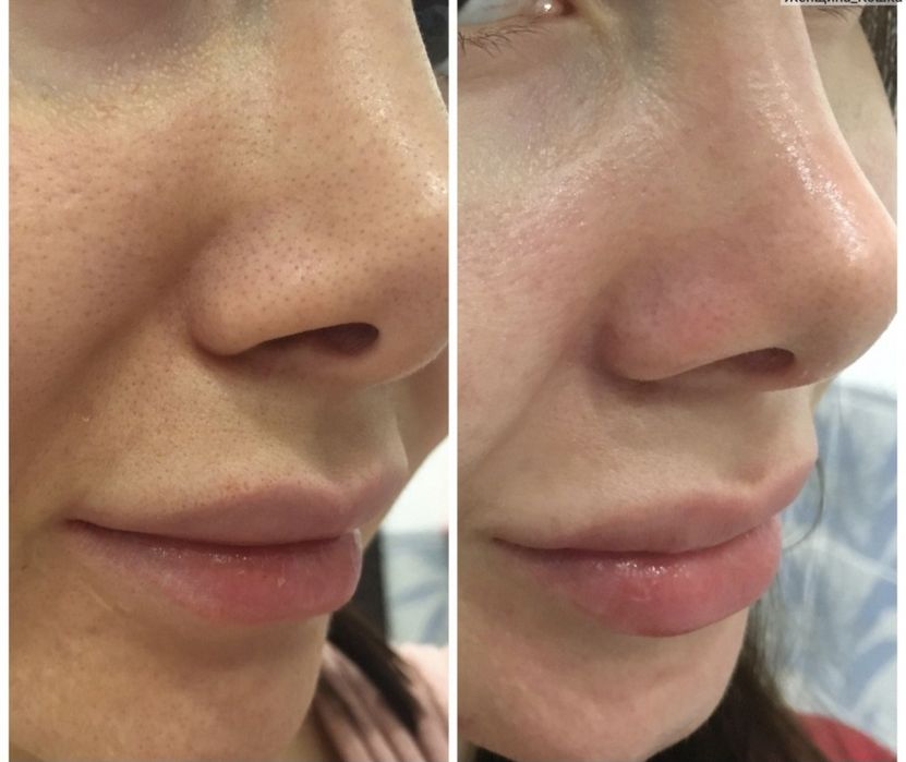 Акция по 250 тысяч Чистка лица ПилингКарбокситерапия механическая чист