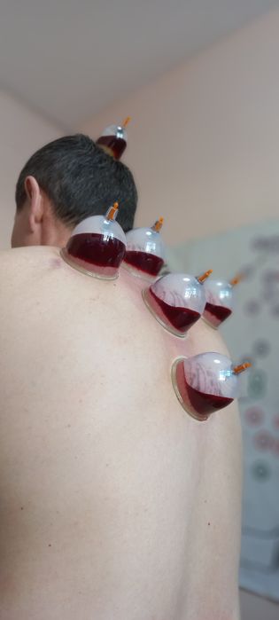 Хиджама профессионально