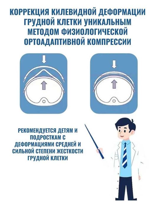 Ортез при килевидной деформации грудной клетки