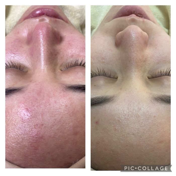 Чистка лица 9 этапная 9900тг