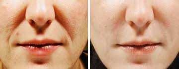 Коррекция носогубных складок филлерами в Ташкенте