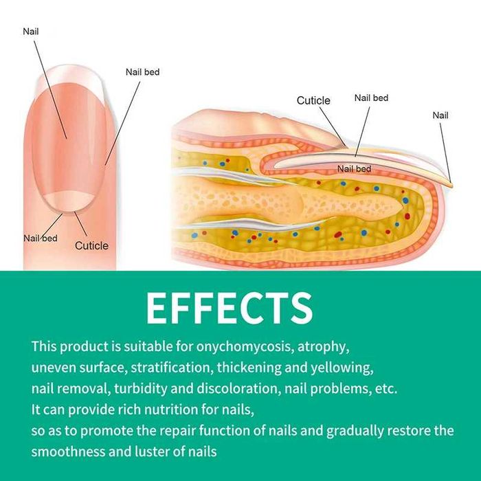 2 Buc.*Crema pentru ciuperca unghiilor, elimina ciuperca, reparator