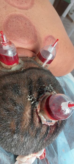 Хиджама/қан шыгару