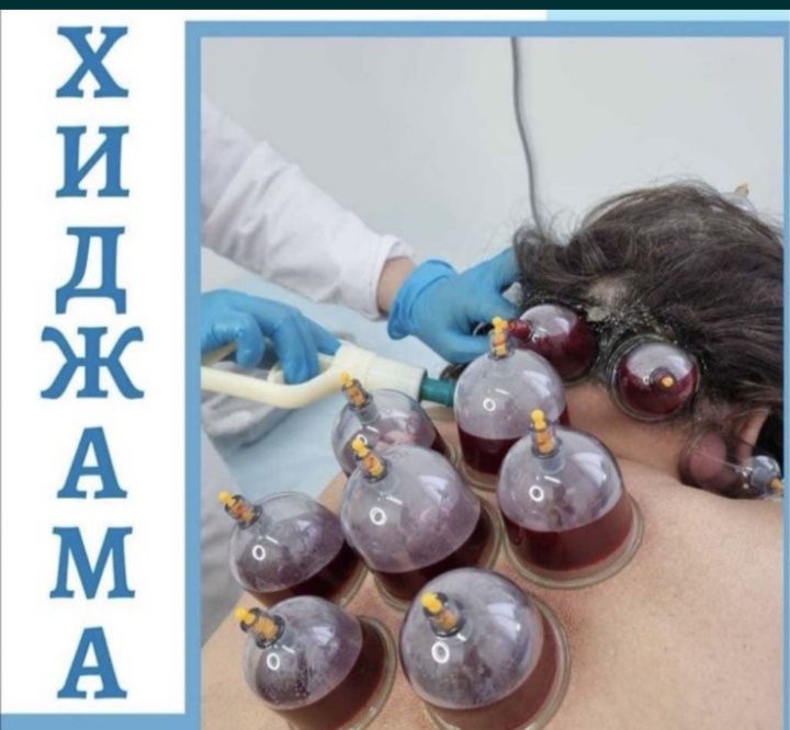 Хиджама. Кровопускание. Шертпе