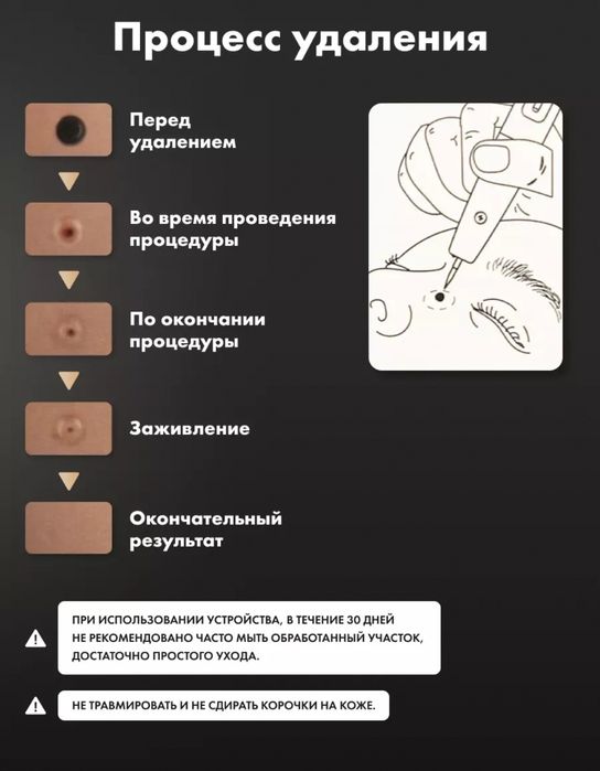 Косметический аппарат для удаления папиллом и бородавок тату