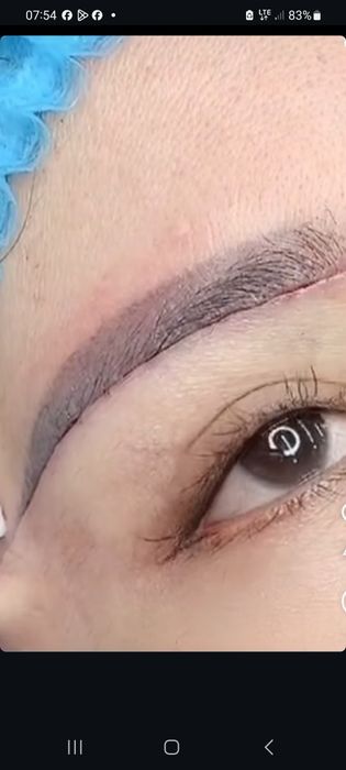-50% CHEGIRMADA Blefaroplastika
