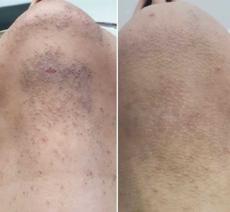 Лазер за епилация под наем