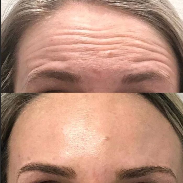 Ботокс и увелечение губ Срочно 50%скидкой места ограничены