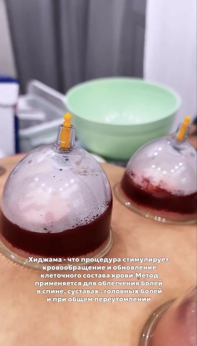 Хиджама - кровопускание по сунне