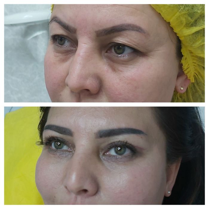 Косметолог блефаропластика,Броулифтинг.Лабиопластика.