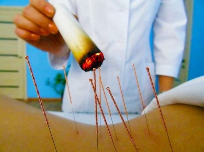 Инетерапиясы, иглоукалывание