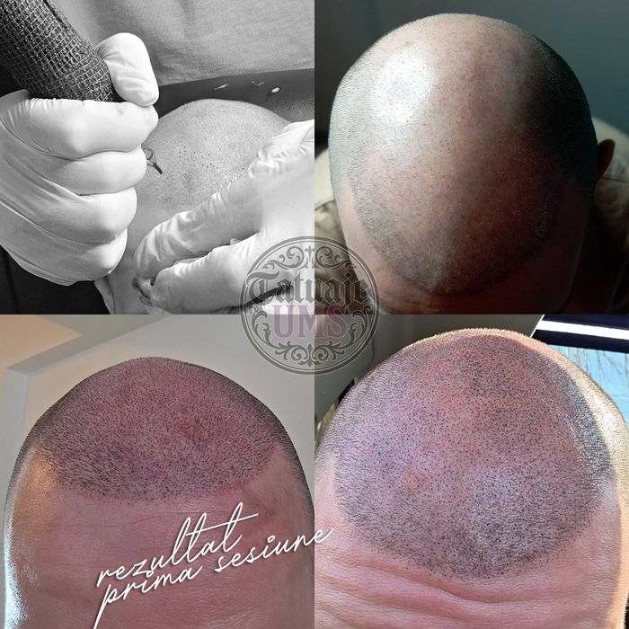 Caut modele pt micro pigmentare SMP scalp chelie / păr rar - tarif mic