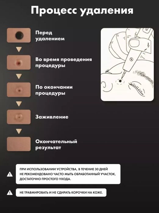 Косметический аппарат для удаления папиллом и бородавок