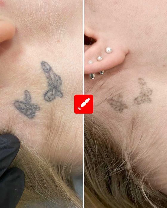 Лазерно Премахване на Татуировки