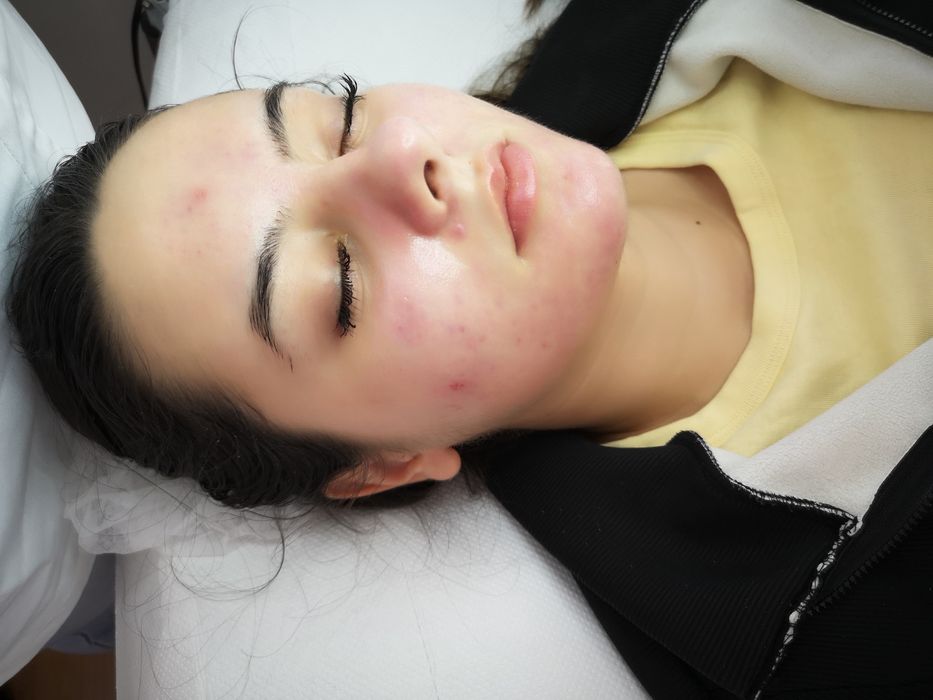 HydraFacial profesional – curățare profundă și hidratare intensă