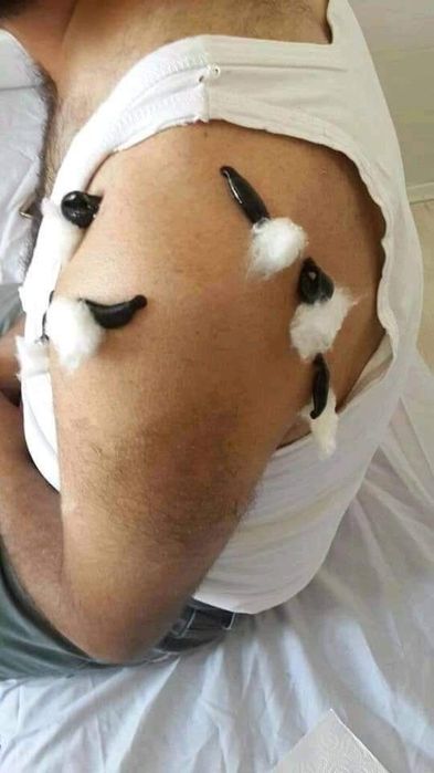 тиббий зулуклар медицинский пиявки гирудотерапия