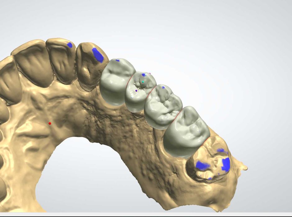 CAD/CAM дизайн |Корони, мостове, барове| 3Shape | Blender for Dental |