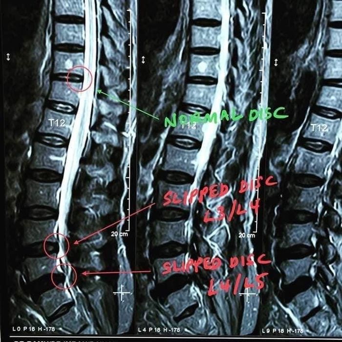 НУГА БЕСТ N5 -кроват кумуртқа поғона чурраси учун ва қон айланиши учун