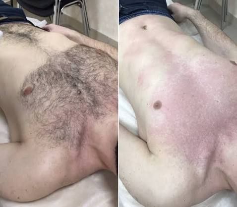 Депиляция для мужчин