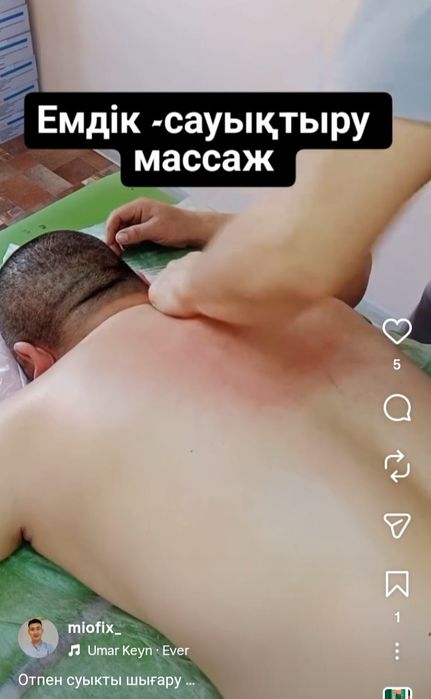 Массаж хиджама иглотерапия