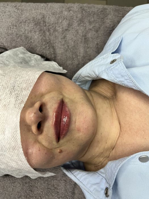 Аугментация губ,Чистка лица,БРВ,Мезотерапия