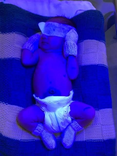 Фотолампа Фототерапия для новорождённых сатилады