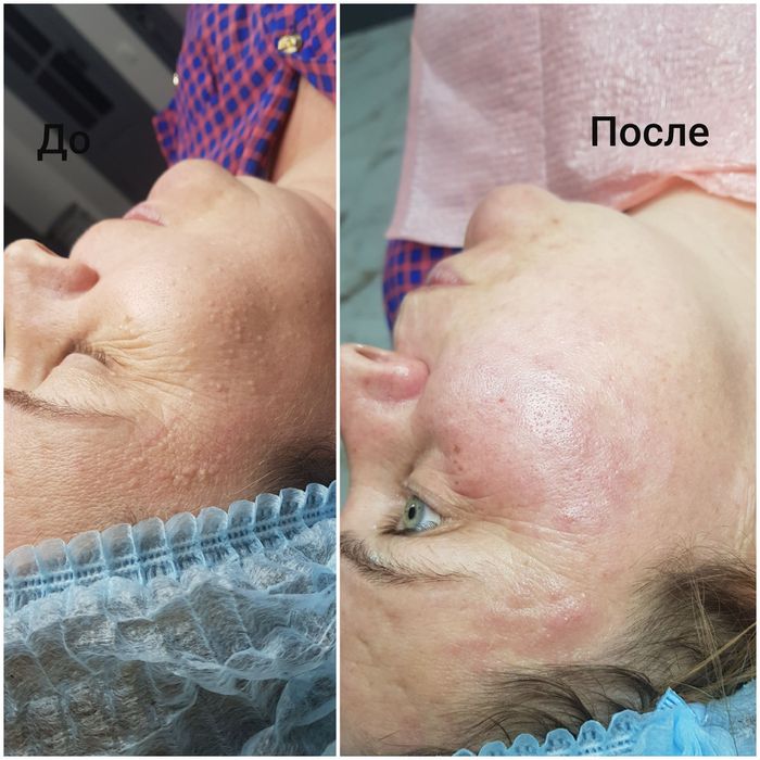 Косметолог.  Чистка лица