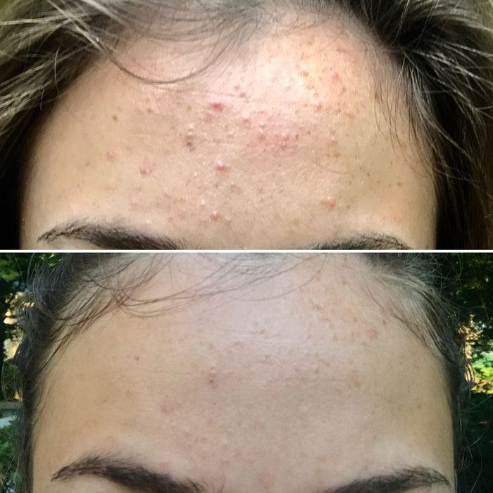 Естественное омоложение холодной плазмой