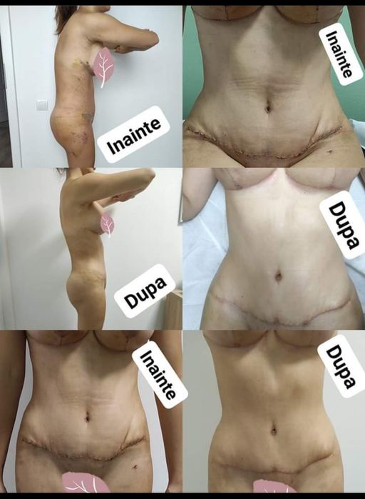 Drenaj limfatic manual post opertor bbl , liposuctie , abdominoplastie