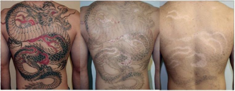 Удаление татуажа и татуировок